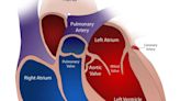 Embolic protection device may prevent some strokes during heart valve operations