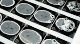 How AI might help in diagnosing mild concussions