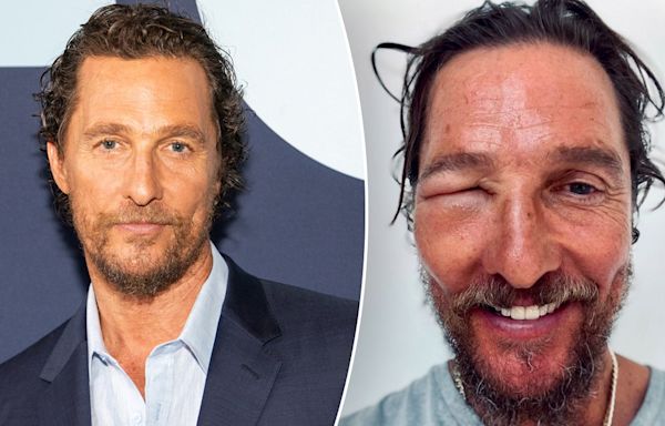 Matthew McConaughey shares shocking image of swollen eye: 'Bee swell'