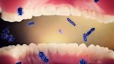¿La gingivitis es contagiosa? Aprende a prevenirla