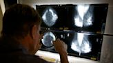 US task force shifts breast cancer screening recommendations to start at age 40