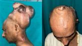 男頭頂「7公斤巨瘤」30年！手術移除變「光頭永澤」