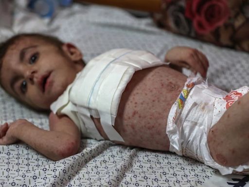 Dangerous Skin Diseases Spreading Among Malnourished Children In Gaza