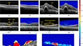 AI technology advances early detection of severe eye inflammation, new research shows