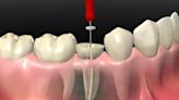 5 Essential Tips for Recovering After Root Canal Treatment