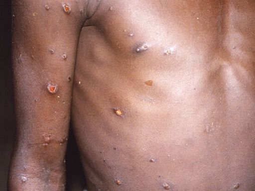 Mpox : Pourquoi l’OMS déclenche son plus haut niveau d’alerte sur la variole du singe