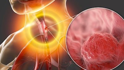 食道癌早期警訊 醫師教你識別 4招預防 | 維生素C | 早期食道癌症狀 | 早期發現 | 大紀元