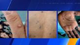 Local transmission of monkeypox virus likely in King County