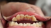 南山首創外溢牙齒險！「洗牙」可領回饋金 安達人壽也有牙齒險