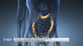 Study: Celebrex reduces risk of colon cancer recurrence — and more
