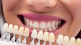牙齒美白方法有哪些？牙醫師解析2大原理及適合方式
