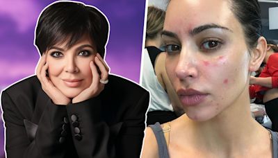 Las enfermedades que Kim Kardashian y su familia ocultaban: tumores, manchas rojas y más