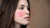 Understanding Rosacea: 10 Natural Ways to Soothe and Calm Red, Irritated Skin