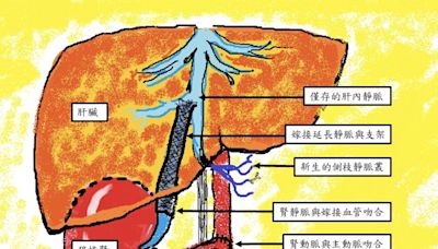 亞洲首例！台北榮總超強 成人腎臟「分肝種腎」：8歲女童脫離洗腎重生 | 蕃新聞