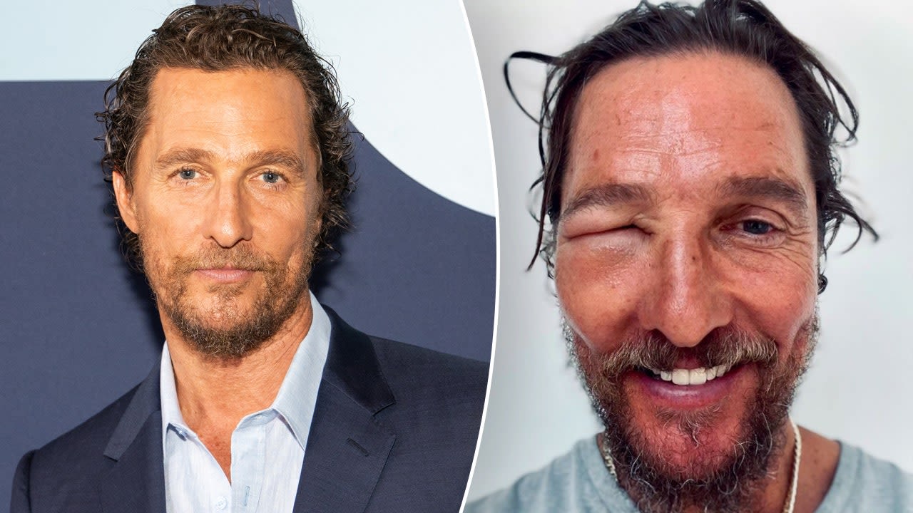 Matthew McConaughey shares shocking image of swollen eye: 'Bee swell'