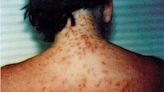 “200 stings or more.” Have you had sea lice after visiting a SC beach? Here’s what to know