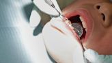 Lawmakers agree to ban mercury-based filling for cavities by 2025