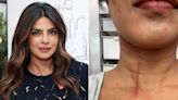 Priyanka Chopra Shares Image of Neck Cut Suffered Doing Stunts on New Movie: ‘Hazards on My Jobs’