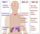 Multiple endocrine neoplasia