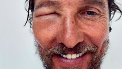 Matthew McConaughey shares shocking photo of eye swollen shut from bee sting