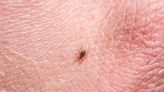 CDC warns another tick-borne illness is on the rise. Know the top symptoms