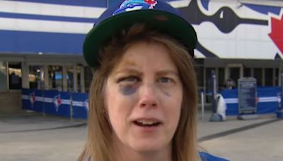 Toronto Blue Jays Fan Hit by 110 MPH Foul Ball Gets Own Trading Card: 'I Got My Face Mashed In'