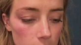 Amber Heard es acusada de retocar fotografías de heridas tras pelear con Johnny Depp