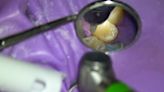 Revealing photos show how a dentist treats a cavity, from slicing and drilling to building the tooth anew