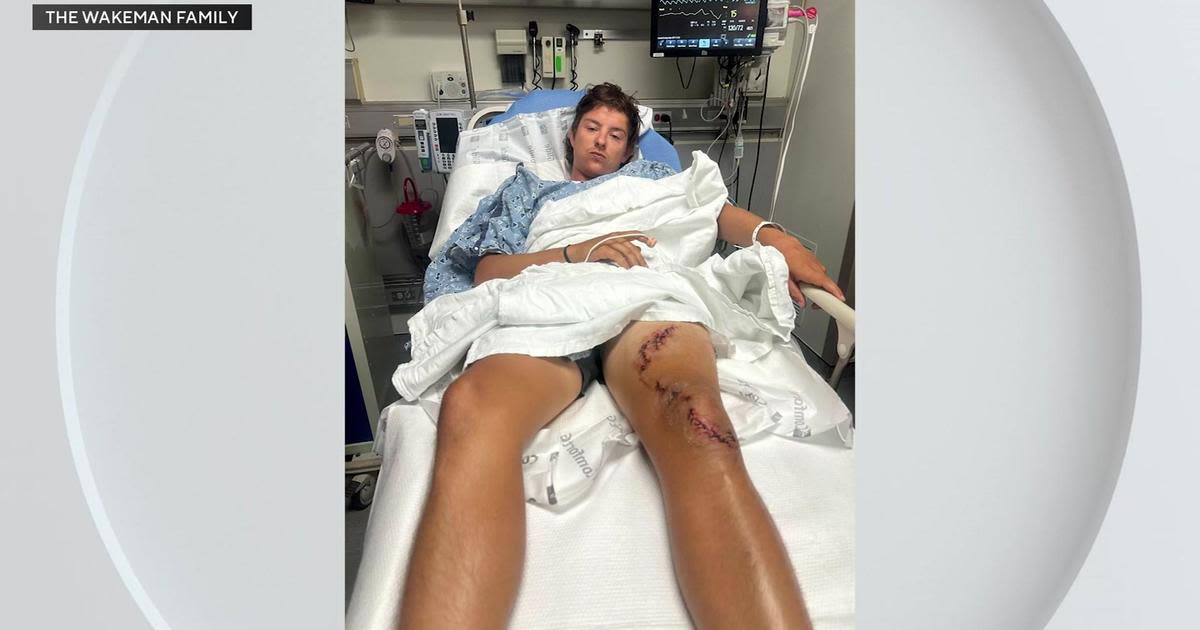 Florida man bitten by two sharks, survives to tell story