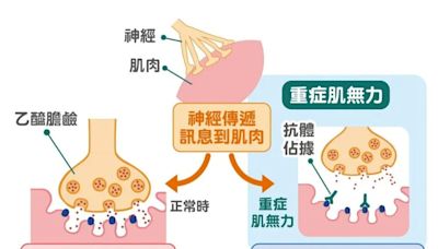 莫名眼皮下垂竟因「肌肉斷電」！神經科醫揭「重症肌無力」4大警訊