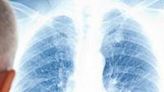 Immunotherapy Before and After Surgery Boosts Lung Cancer Survival