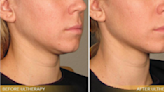 Ultherapy Can Give You the Jawline You Always Wanted in One Session