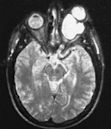 Optic nerve glioma