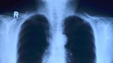 Machine learning uses lung cancer scans to predict heart damage