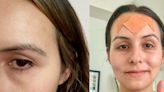 I tried both Botox and face tape for my forehead lines. Neither is perfect, but one feels better in the long run.