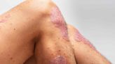 Why Does Psoriasis Show Up on Knees?