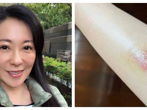 況明潔手腫成包子！她被蚊子叮沒管 醫驚呼：險釀蜂窩性組織炎