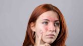 What Is Rosacea?