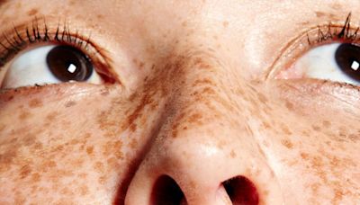 Freckles Are 'In' Now — And People Who Grew Up Hating Theirs Have Thoughts