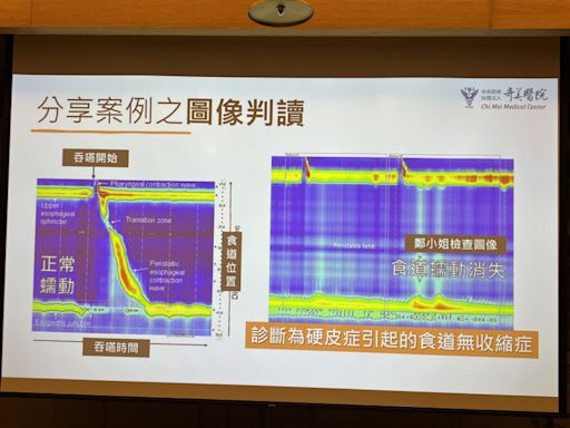 女罹硬皮症胃食道逆流 精準檢查驚見「食道罷工」 - 自由健康網