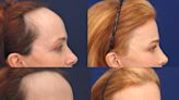 A plastic surgeon who performs forehead reduction surgeries to lower hairlines shares before and after photos, and what to expect
