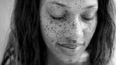 Dermatosis Papulosa Nigra: The Beautiful Skin Feature More People Are Embracing