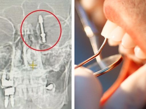 土耳其男接受植牙險喪命 牙醫太用力「螺絲直插頭骨」場面驚嚇