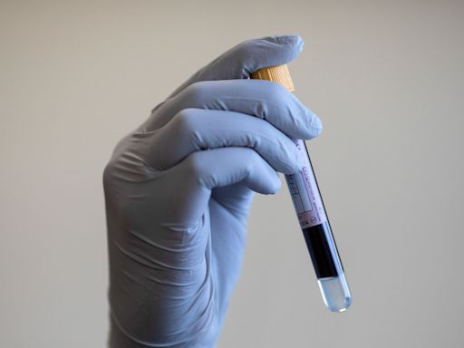 Blood test powered by AI ‘could detect infertility in men without semen testing’