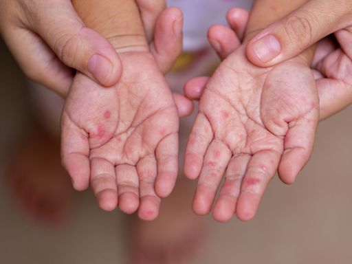 Hand, foot, mouth disease spreads in San Antonio as temps rise