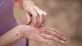 What Is Contact Dermatitis?