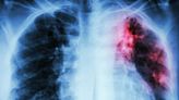 Tuberculosis warning as cases of disease rise for first time in decades in Europe