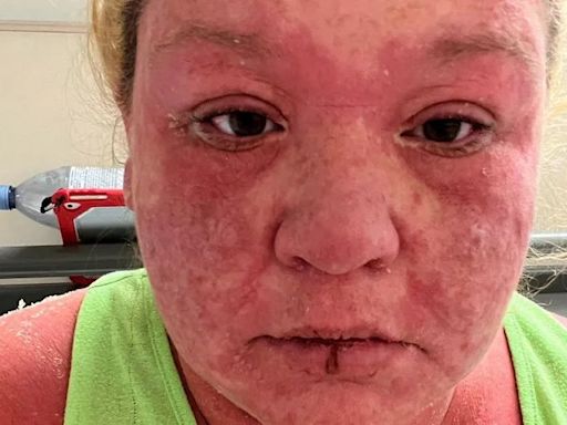 'My hair, nails and skin fell off after mosquito bite on holiday'