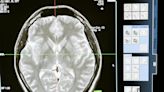 Findings support a more cautious approach to early decision-making for brain injury patients receiving life support