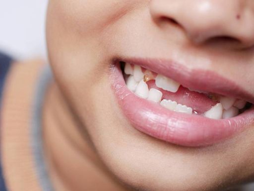 健康網》你剩幾顆牙？ 牙醫：缺牙不補恐釀7後果 - 自由健康網